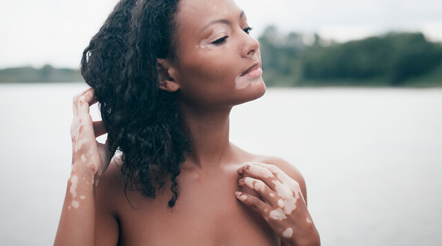 Mulher que sofre de vitiligo ao ar livre a mexer no cabelo.